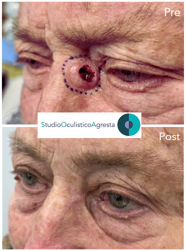 Carcinoma basocellulare pre e post studio oculistico agresta