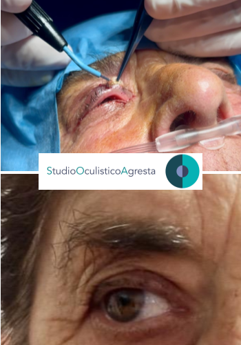 Cisti epidermoide asportata con radiobisturi studio oculistico agresta